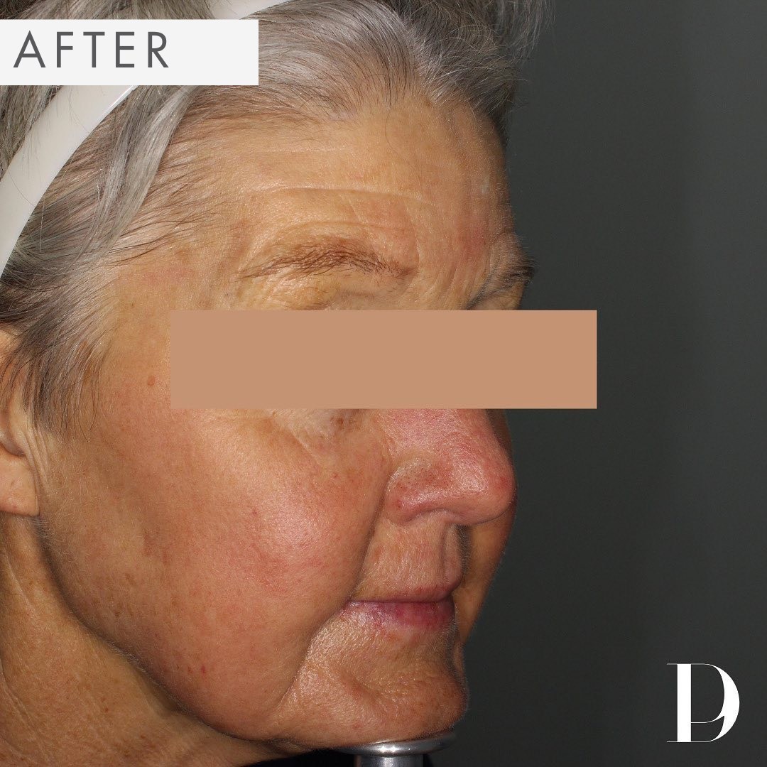 After Treatment