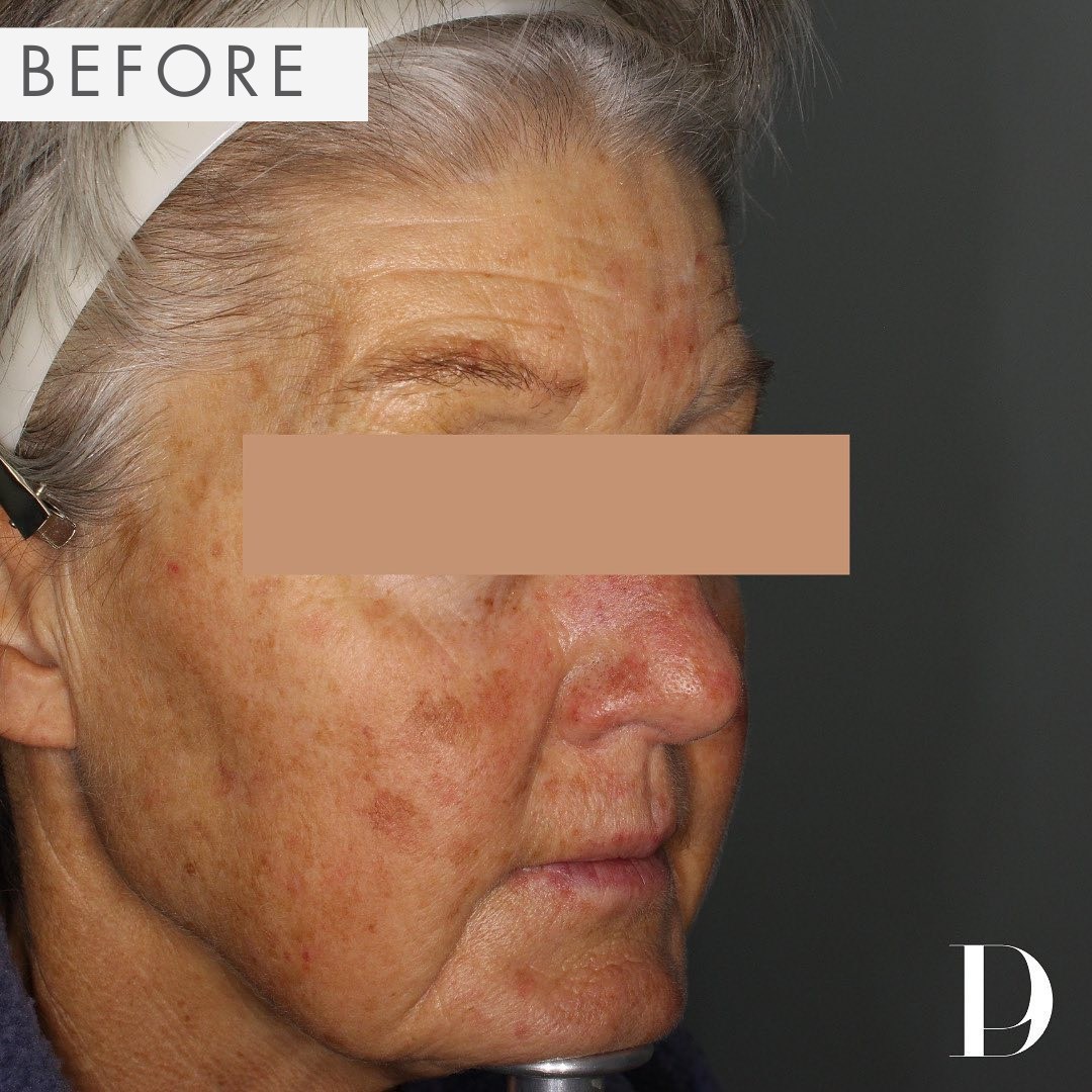 Before Treatment